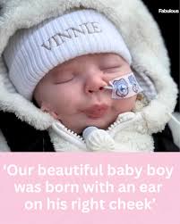 We hope he will inspire others." Read the full story ➡️  https://www.thesun.co.uk/health/33570176/baby-boy-born-ear-right-cheek/?utm_medium=Social&utm_campaign=fabulousfacebookengagement&utm_source=Facebook