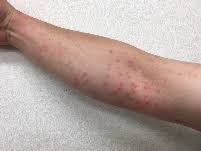 毛虫に刺されるとこうです スタッフブログ 熊谷のエクステリアプランナーが綴るブログ 発信は諒心工業 埼玉県熊谷市