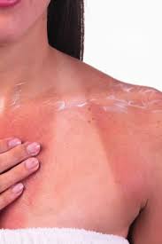 Image result for Sunburn