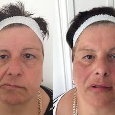 Maybe you would like to learn more about one of these? Bell S Palsy Victim Reveals How She Is Smiling For Pictures Again Thanks To Cutting Edge Treatment Daily Record
