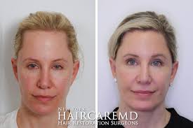 A widow's peak hairline can form early on in childhood or later on in life as a result of hair loss. The Art Of Lowering The Female Hairline Haircaremd