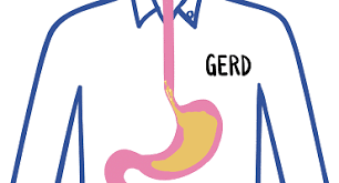 When you have gerd (chronic acid reflux) your stomach acid persistently flows back up into your mouth through your esophagus. Gastroesophageal Reflux Disease Gerd Video Gastrointestinal Society