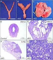 It occurs due to the abnormal growth of cells in the lining. Activin Like Kinase 5 Alk5 Inactivation In The Mouse Uterus Results In Metastatic Endometrial Carcinoma Pnas