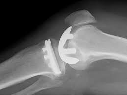 The best treatment method of renal failure is kidney transplantation. Prothese Partielle Du Genou L Articulation Complete N Est Pas Toujours A Remplacer Hirslanden Blog