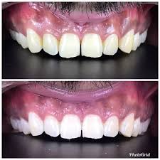 We did not find results for: Dentistry How Much Rupees Yellow Teeth Whitening Costs Quora