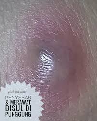 Lipoma adalah benjolan berisi lemak yang tumbuh tepat di bawah lapisan kulit dan merupakan masalah kesehatan yang awam. Emak Bisulan Di Punggung Penasaran Apa Penyebabnya Ysalma