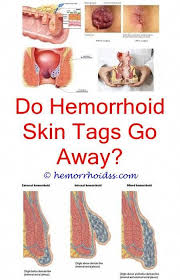Sometimes the walls of these blood vessels stretch so thin that the veins bulge and get irritated, especially when you poop. Essential Oils For Animals Bleeding Hemorrhoids Hemorrhoids Treatment Hemorrhoid Remedies