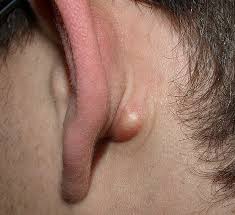 Vous souffrez de microkystes, boutons sous la peau et cherchez une solution naturelle pour vous les microkystes apparaissent sous la peau suite à l'obturation du canal pilaire par lequel s'écoule le bonjour, je souffre d'acné hormonal qui me fait pousser de gros boutons surtout autour du menton. Kyste Le Kyste Sebace Teleconsultation Dermatologue