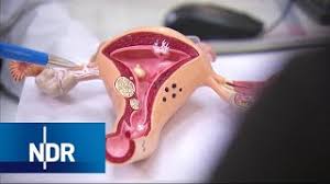 Verrückterweise wollte ich zwar keine kinder mehr, fühlte mich danach aber irgendwie nicht mehr komplett. Innimathog Gewichtszunahme Nach Gebarmutterentfernung