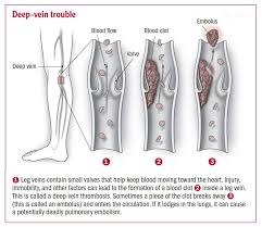 Deep Vein Thrombosis Harvard Health