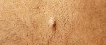 atherom grutzbeutel entfernen behandlung mit salbe