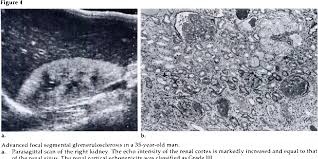Radiographic features ultrasound it can be seen as a triangular echogenic cortical defect, frequently seen i. Pdf Renal Parenchymal Disease Sonographic Histologic Correlation 1 Semantic Scholar
