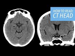Image result for CT Head