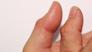 Jari tangan kaku mungkin dapat disebabkan oleh pergerakan jari tangan atau jempol yang dipaksakan dan berulang. Penyebab Jempol Bengkak Dan Cara Mengatasinya