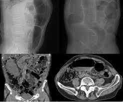 Si l'un des organes internes est enflammé ou infecté, l'état de santé se détériore fortement. Volvulo Del Colon Sigmoides Diagnostico911 Org