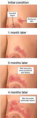 A lot of breast cancers are detected at an early stage, by breast. Red Rash On Breast Pic September 2019 Babies Forums What To Expect