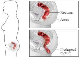 Image result for Rectal Prolapse