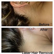 How many laser treatments to. Laser Derm Med Spa Medical Spas 5025 Expwy 83 Mcallen Tx Phone Number Yelp