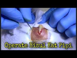 Penyebab bisul adalah infeksi bakteri staphylococcus aureus. Bisul Besar Meletop Drman Ttdi Youtube