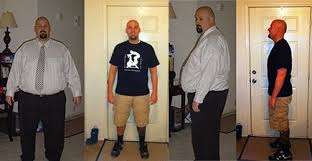 Pin On Weight Loss Surgery