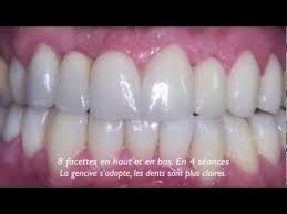 Facettes Dentaires Avant Apres Realisation Dr Jacques Nahon Youtube