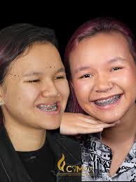 ✨Transforma tu sonrisa 😃 con ORTODONCIA ✨ En manos de un especialista el  Dr.Marvin Benavides ✓ Contamos con diferentes tipos de brackets ✓ Sin Prima  ✓ Cómodas cuotas ✓ Contamos con centro