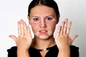 Check spelling or type a new query. Ù…Ø±Ø¶ Ø§Ù„Ø¨Ù‡Ø§Ù‚ Ø¨Ø§Ù„ØµÙˆØ± ØµÙˆØ± ØªØ¸Ù‡Ø± Ù„Ù†Ø§ Ù…Ø±Ø¶ Ø§Ù„Ø¨Ù‡Ø§Ù‚ Ø§Ø­Ø¶Ø§Ù† Ø§Ù„Ø­Ø¨