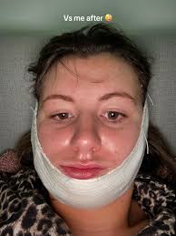 Wisdom Tooth Removal Anna Before and After