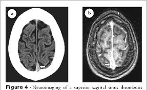 As a result, blood cells may break and leak blood into the brain tissues, forming a hemorrhage. Figure 4 From Cerebral Venous Sinus Thrombosis In Saudi Arabia Semantic Scholar