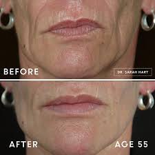 Before and after botox photos by dr. Gallery Before And After Photos By Dr Sarah Hart