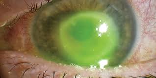 A contact lens that gets stuck in the eye is usually a soft contact lens rather than a gas permeable lens. Woman Nearly Loses Sight In One Eye After Wearing Contacts In Shower And Pool
