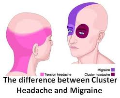 The Difference Between A Headache And A Migraine Cluster Headaches Migraine Vs Headache Migraine Prevention
