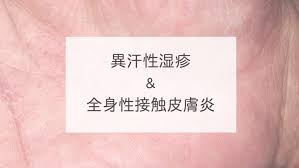 Discover (and save!) your own pins on pinterest. ç•°æ±—æ€§æ¹¿ç–¹ å…¨èº«æ€§æŽ¥è§¦çš®è†šç‚Ž ã—ã‚€ã‚‰çš®è†šç§'ã‚¯ãƒªãƒ‹ãƒƒã‚¯ã®ãƒ–ãƒ­ã‚°