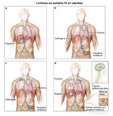 El linfoma de hodgkin clásico tiene 4 subtipos histológicos (ver subtipos histopatológicos de linfoma de hodgkin (clasificación de la oms)); Tratamiento Del Linfoma De Hodgkin En Adultos Pdq Version Para Pacientes Instituto Nacional Del Cancer