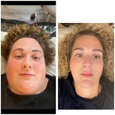 Weight loss progress and bariatric surgery recommendations