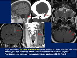 Thrombosis is the process of a blood clot, also known as a thrombus, forming in a blood vessel. Figure 6 From La Trombosis Venosa Cerebral Un Reto Diagnostico Semantic Scholar