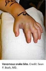 Image result for Snake Bite