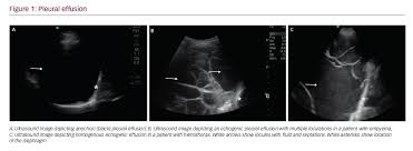 A loculated pleural effusion is the major radiographic hallmark of parapneumonic effusion or empyema (see fig. Practice Pearls For Performing Pleural Ultrasound With Focus On Pleural Effusion And Pleural Thickening Touchrespiratory