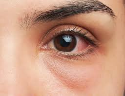 Kondisi ini adalah ketika kelopak mata bergerak sendiri secara berulang. 12 Penyebab Mata Pedih Merah Dan Cara Mengatasinya Honestdocs