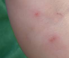 Mite Bite Transmission Hearts Pest Management