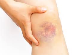 Eine Prellung Ist Schmerzhaft Doc Gegen Entzundungsbedingte Schmerzen