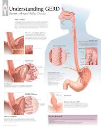 Understanding Gerd