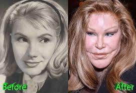 Pin On Celebrity Plastic Surgery