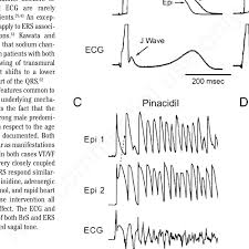 Image result for Early Repolarization