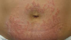 Image result for Generalized Rash
