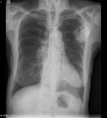 Cardiac Failure With Kerley B Lines Radiology Case Radiopaedia Org On the image on the left notice the following cardiac failure with kerley b lines