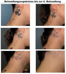 tattooentfernung ohne laser print
