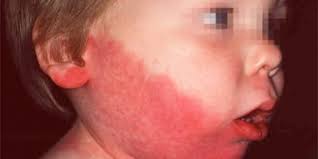 Manchas rojas en la piel. Manchas Rojas En La Cara Causas Y Tratamientos Naturales