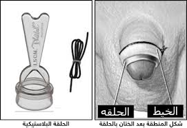 ختان الطفل بالحلقة البلاستيكية اجمل بنات