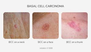 We also explore how it is diagnosed and the many treatment options now available should you be unfort. Skin Cancer Pictures Most Common Skin Cancer Types With Images